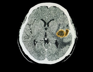 RNA Splicing Errors May Hold the Key to Beating Gliomas Using Immunotherapy