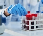 New Blood Test Could Revolutionize Alzheimer’s Diagnosis