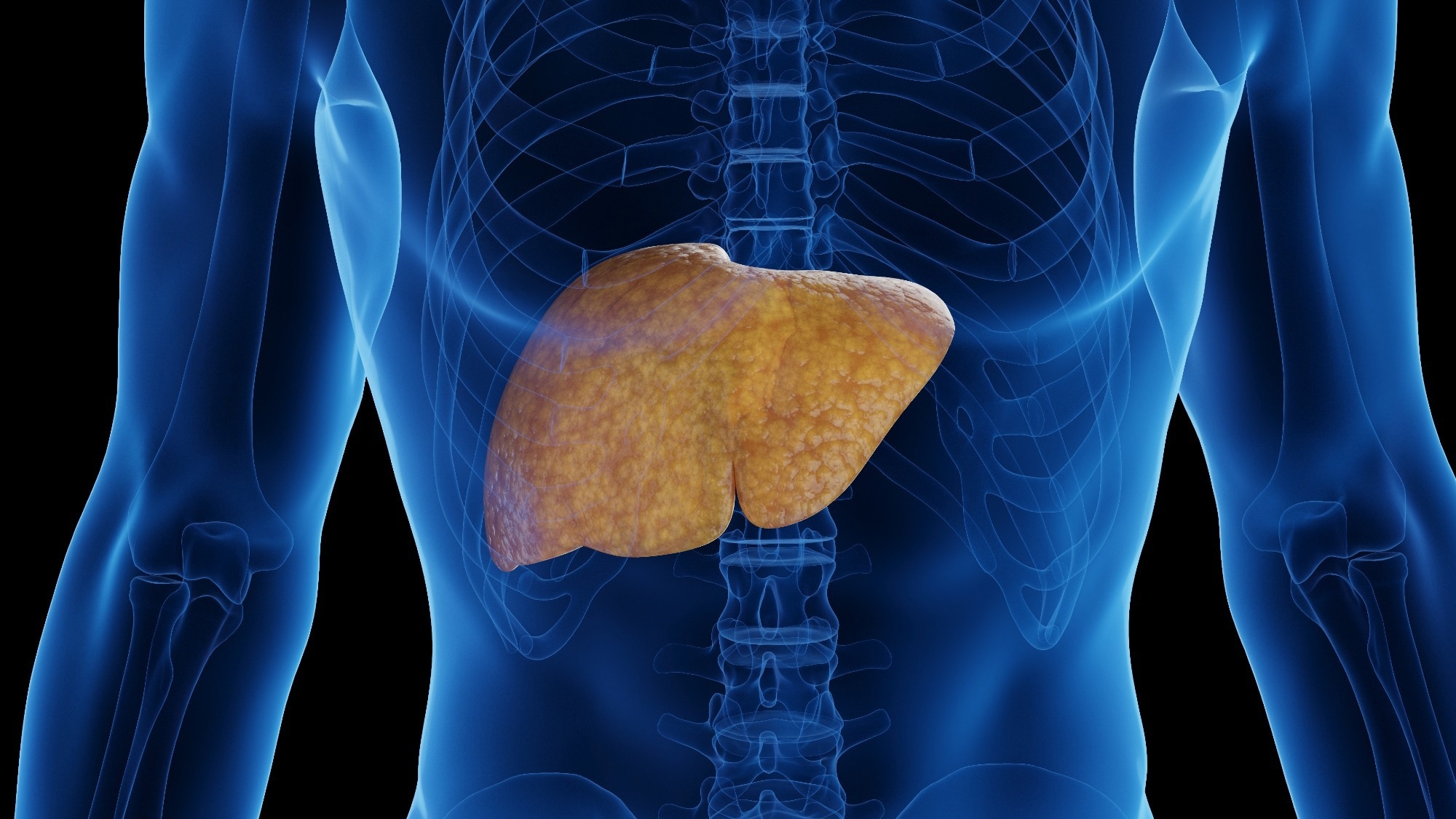 3D rendered medical illustration of male anatomy - fatty liver.