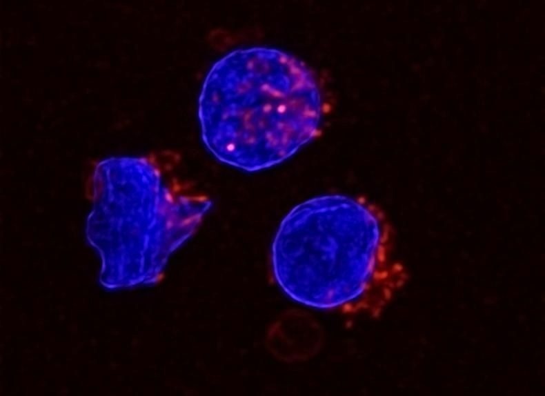 Lipid-Rich Ascites Weakens Immunity in Advanced Ovarian Cancer