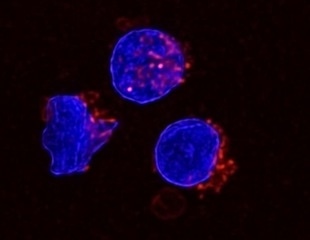 Lipid-Rich Ascites Weakens Immunity in Advanced Ovarian Cancer