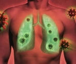 Study Reveals Genetic Predisposition to Long COVID Near Lung-Related Gene
