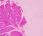 Study Identifies SMARCB1 and MEOX2 Genes as Growth Regulators of Lung Cancers