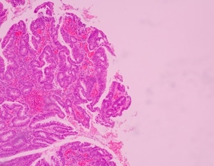 Study Identifies SMARCB1 and MEOX2 Genes as Growth Regulators of Lung Cancers