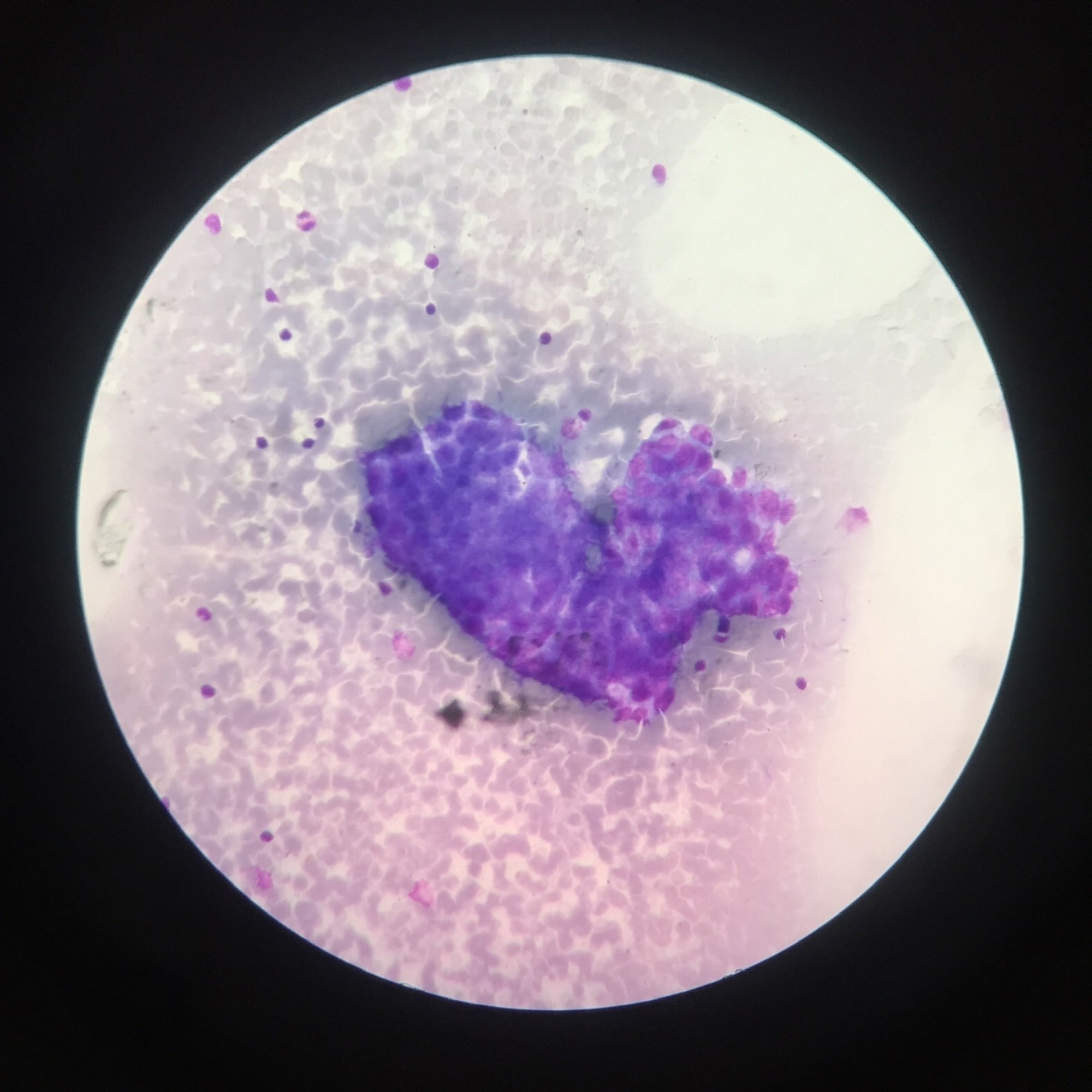 Metastasis ovarian cancer are found in the fluid (ascites)