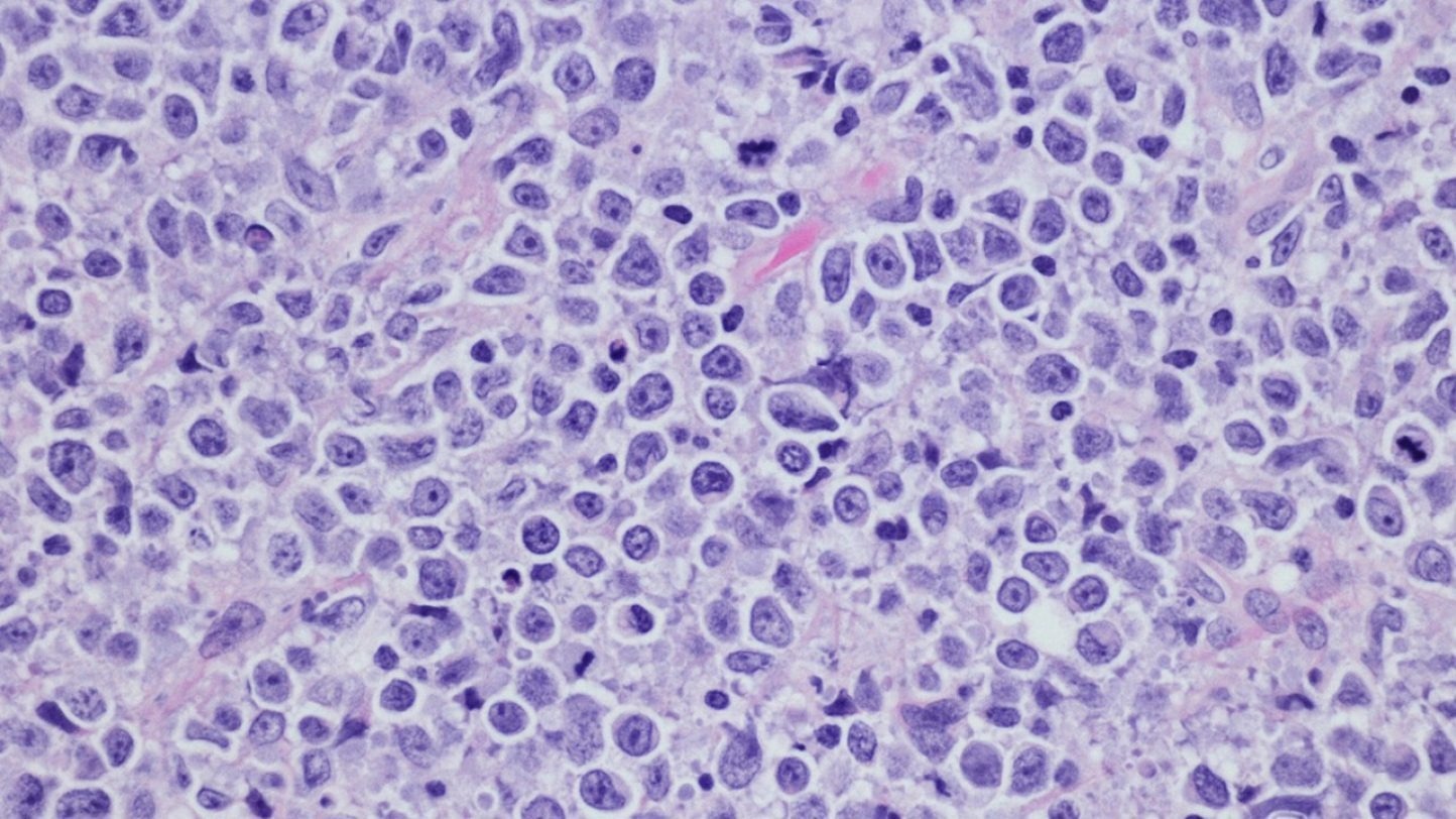 New Study Reveals Varied CAR T-Cell Therapy Benefits in Large B-Cell Lymphoma