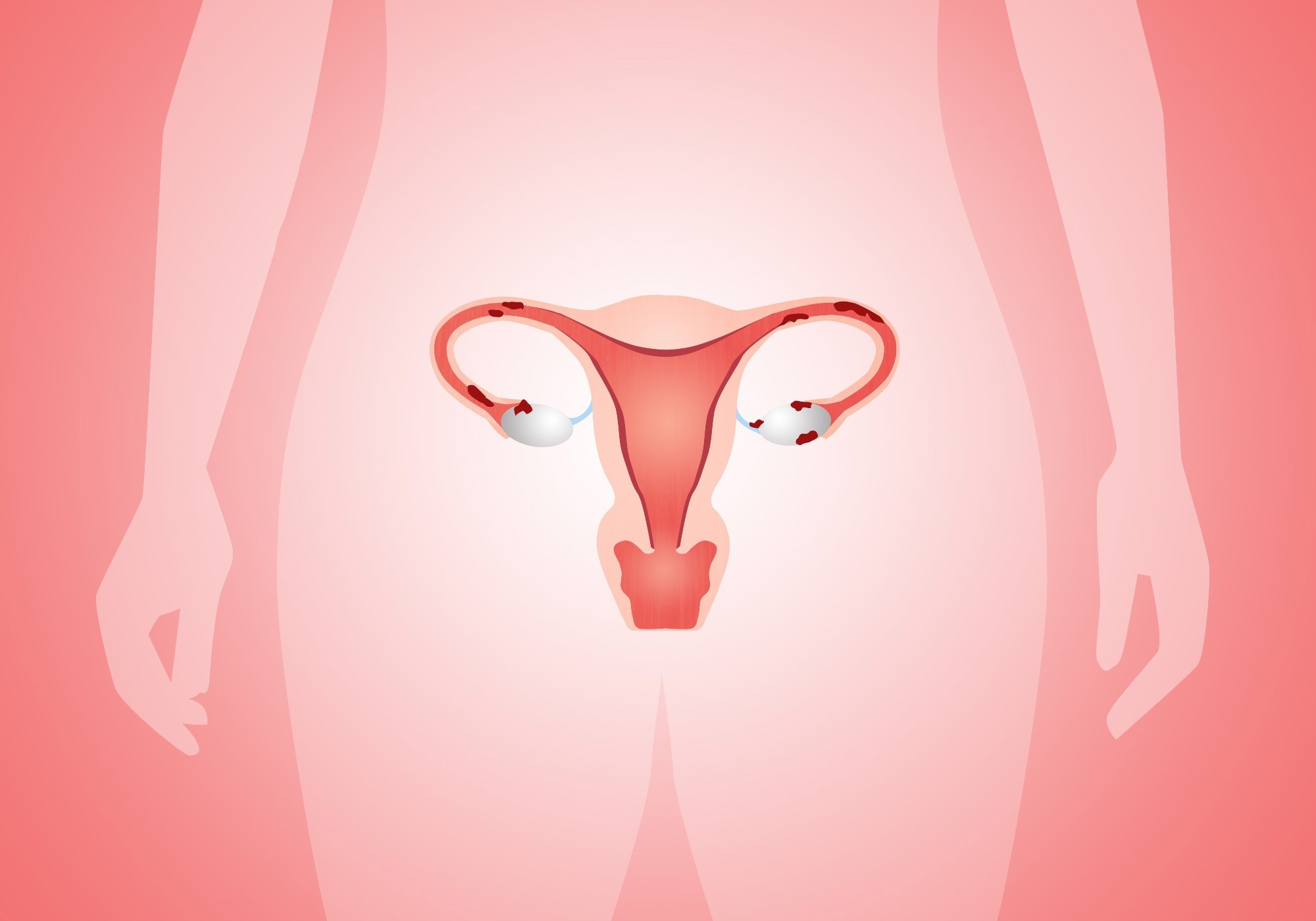 uterus with Endometriosis in woman