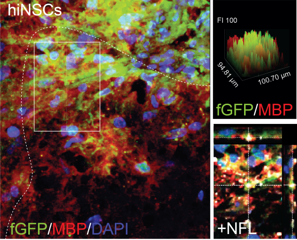 Evidence for Neural Stem Cell-Based Therapies in Multiple Sclerosis