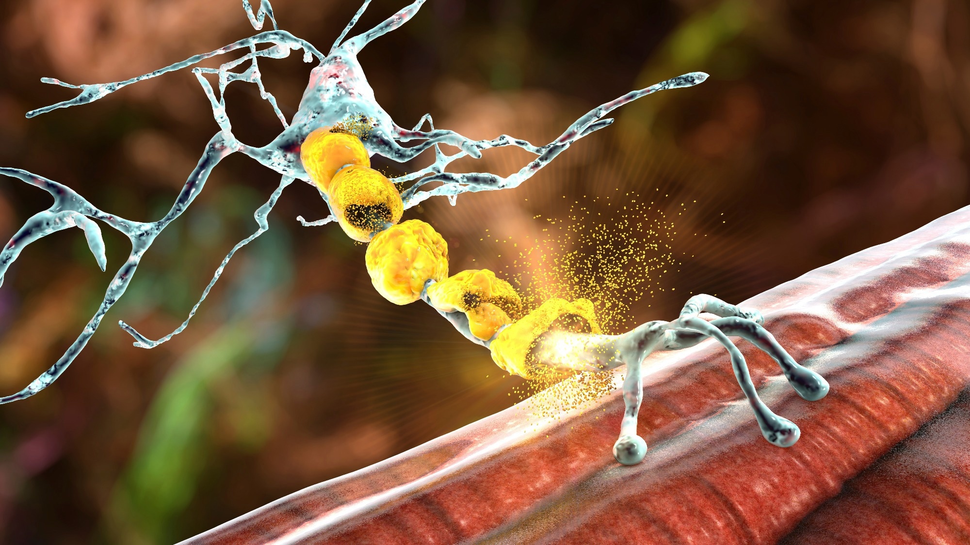 Demyelination of neuron