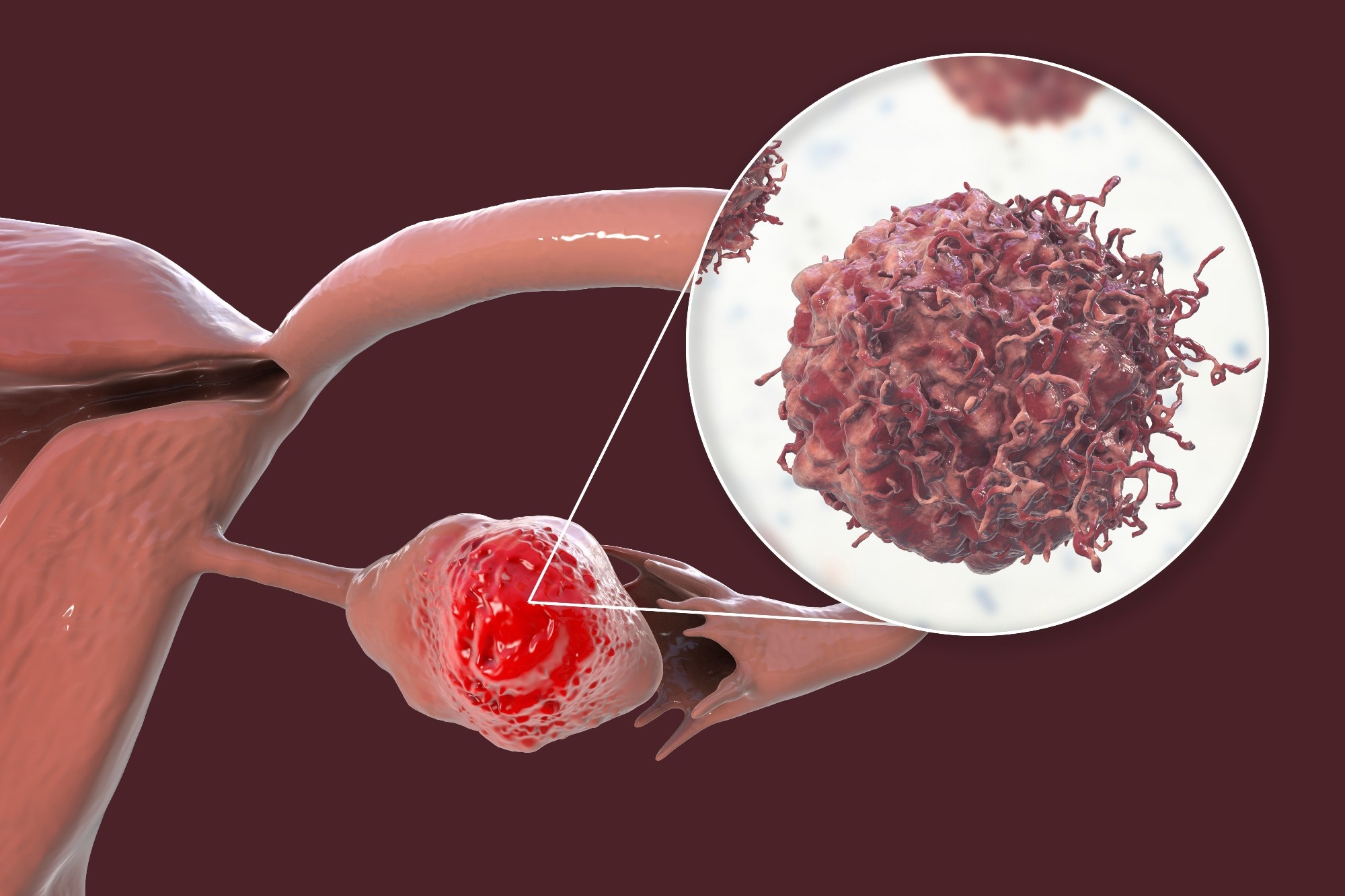 Ovarian cancer, 3D illustration