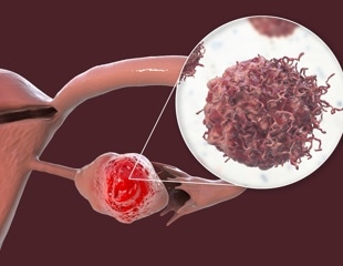 Blocking TG2 Could Help Immune Cells Attack Ovarian Tumors