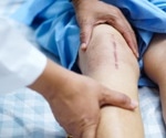 Hemostatic Dressing Developed for Severe Burn Injuries