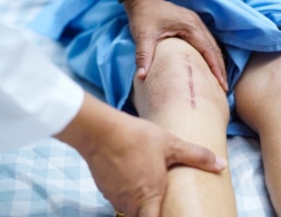 Hemostatic Dressing Developed for Severe Burn Injuries