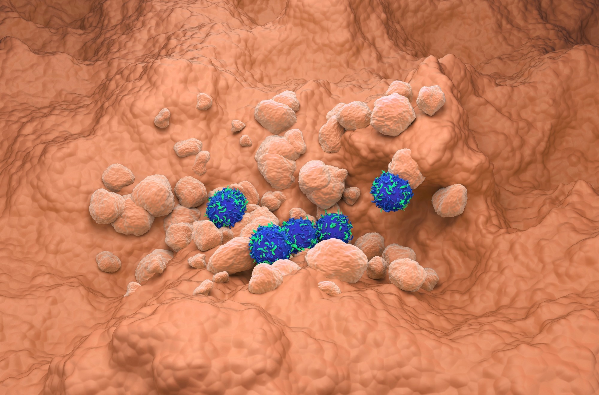 Non Small Cell Lung Cancer (NSCLC) in the lung tissue - isometric view 3d illustration