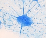 Case Western Researchers Use Stem Cells to “Shut Off” Nerve Cell Strain