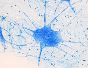 Case Western Researchers Use Stem Cells to “Shut Off” Nerve Cell Strain
