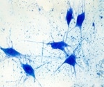 Parkinson’s Gene Mutation Blocks Vital Neuroprotective Signals