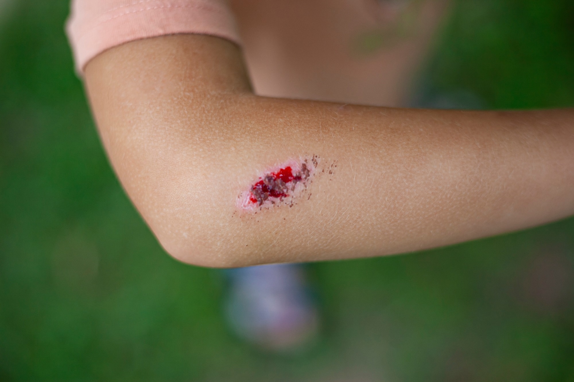 Deep scratches on the skin of the children
