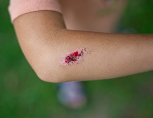 Human-Derived 3D Skin Model May Replace Animals In Wound Studies