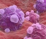 FSH: A Promising Biomarker For Endometrioid Ovarian Cancer?