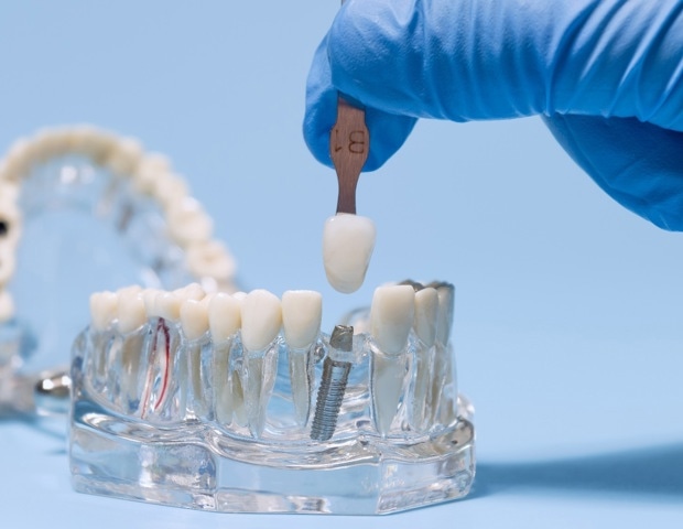Built Oral Biofilm Models Reveal How Peri-Implantitis Develops