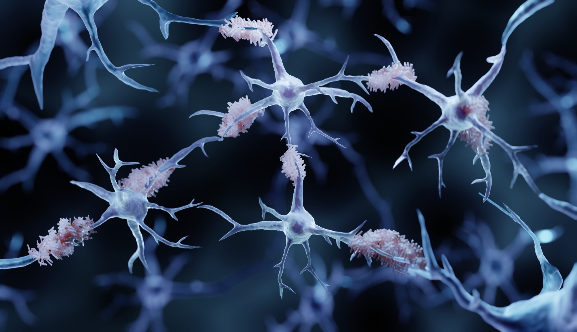 Amyloid plaques in Alzheimer