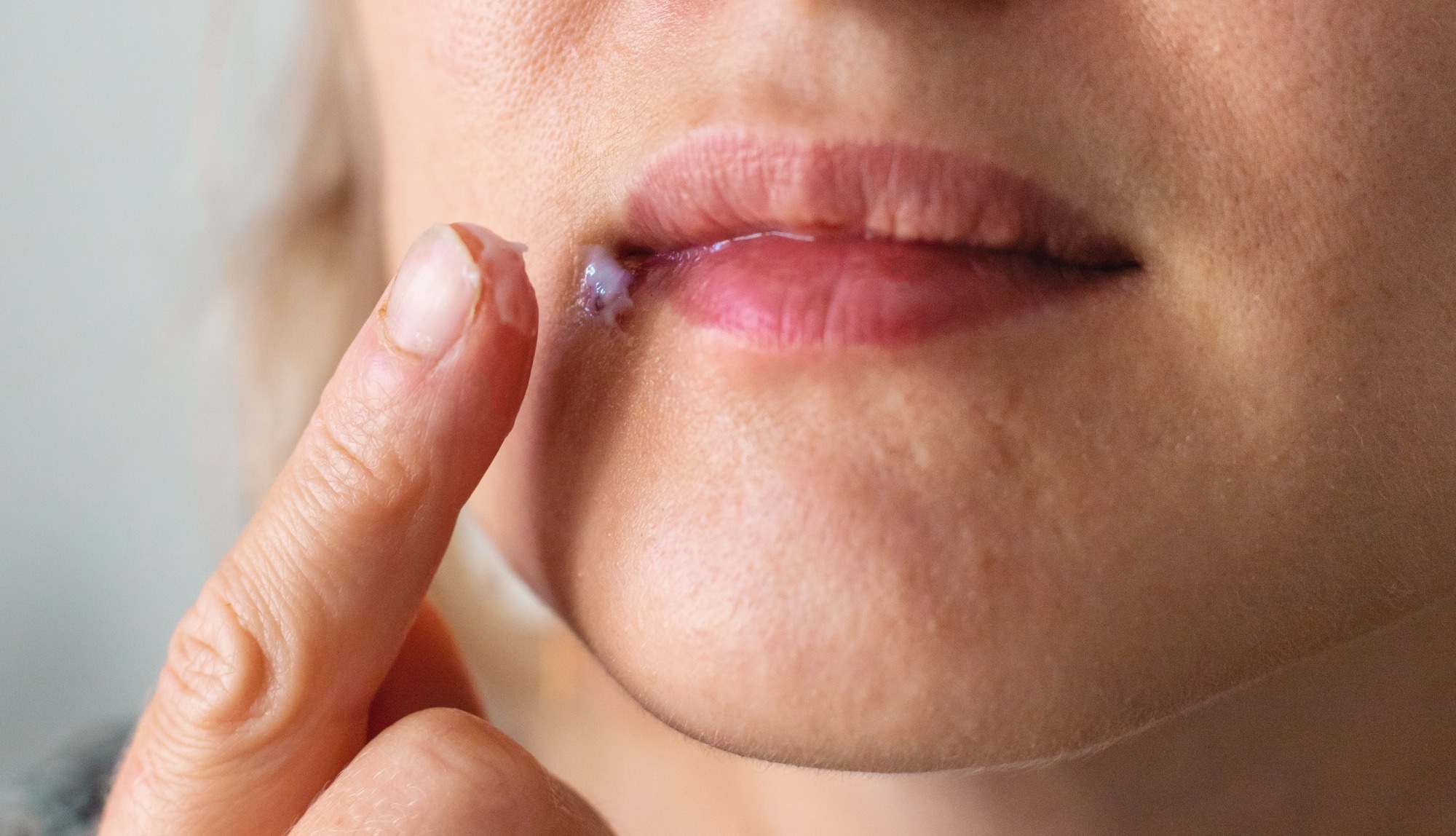 Image Credit: Tatevosian Yana/Shutterstock.com An image showing herpes on a woman