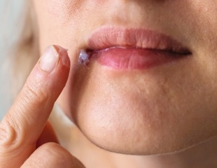 Breakthrough Cryo-EM Study Maps Herpes Replication Protein in New Detail