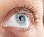 Retinal Implant Restores Sight for Patients With Macular Degeneration
