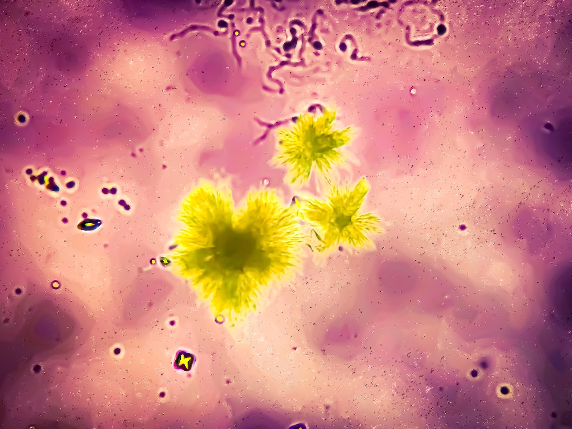 Bilirubin crystals in urine sediment analysed by light microscope. 40x