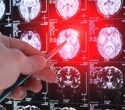 Lecanemab doesn’t improve early brain waste-clearance in Alzheimer’s