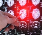 Lecanemab doesn’t improve early brain waste-clearance in Alzheimer’s
